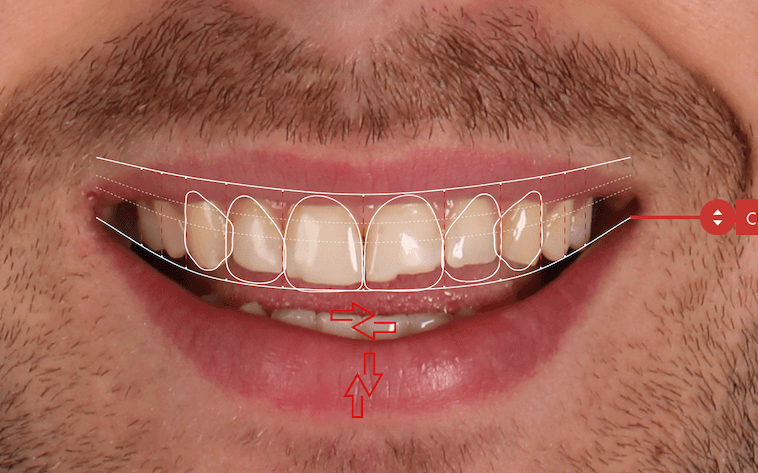 2D Smile Design